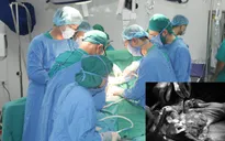 Phẫu thuật cắt gan - Lựa chọn điều trị triệt để ung thư gan