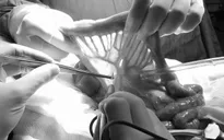 Ghép nối ruột tái tạo đường ăn cho người bệnh ung thư thanh quản hạ họng