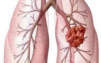 Liệu pháp nhắm trúng đích trong điều trị ung thư phổi
