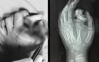 Bé 6 tuổi đứt rời ngón tay khi cho tay vào máy giặt đang hoạt động