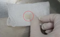 Học theo trò chơi trên mạng, bé gái 4 tuổi phải nhập viện lấy dị vật trong mũi