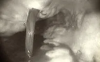 Tối cấp cứu, cứu sống bệnh nhân xuất huyết tiêu hóa, nôn ra máu do giãn vỡ tĩnh mạch thực quản
