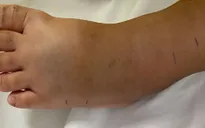 Chơi ở vườn nhà, bé 4 tuổi bị rắn lục đuôi đỏ tấn công