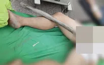 Cấp cứu thành công nạn nhân bị cọc gỗ 1,5m đâm xuyên tầng sinh môn
