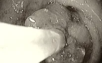 Xuất huyết tiêu hóa, hẹp môn vị do bã thức ăn