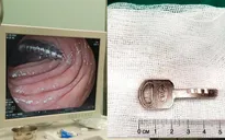 Lấy đinh ốc, chìa khóa trong... dạ dày hai cháu bé