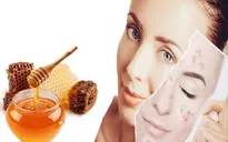 Bạn sẽ có làn da sáng mịn nếu trị thâm mụn theo cách này!