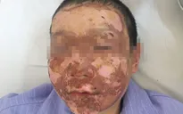 Nhiều trẻ nhập viện do bỏng cồn, pháo tự chế