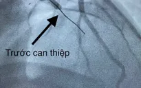 10 phút can thiệp cứu sống bệnh nhân nhồi máu cơ tim biến chứng ngưng tim