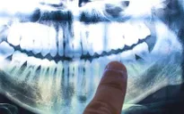 Bí ẩn những đường “vòng cây” kỳ lạ trong răng con người