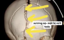 Cửa kính đè lên người, bé trai bị chấn thương sọ não