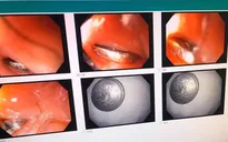 Vào viện cấp cứu giữa đêm vì đồng xu mắc ở họng