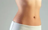 Mẹo khắc phục rạn da hiệu quả tại nhà