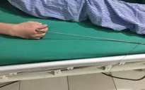 Ra suối bắn cá bằng súng tự chế, bé trai 13 tuổi bị mũi tên kim loại dài 60cm xuyên vào tay