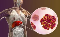 Tự ý dừng uống thuốc kháng virus viêm gan B - hậu quả khó lường
