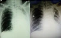 Cảnh giác tình trạng tắc nghẽn đường thở