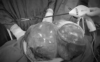 Cắt bỏ tử cung và khối u xơ năng hơn 5kg cho một phụ nữ