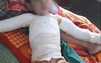 Chơi bật lửa, bé trai bị lửa bén cháy quần áo gây bỏng nặng
