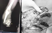 Sơ ý lúc làm việc, người đàn ông bị máy vò chè quấn nát tay