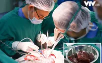 Giành lại cuộc sống cho bệnh nhân ung thư gan qua 2 cuộc phẫu thuật liên tiếp