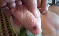 Bé 1 tháng tuổi mắc giang mai bẩm sinh từ mẹ