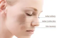 Tất cả những điều bạn cần biết về “tăng sắc tố da”
