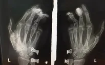 Bị thương nặng do điện thoại phát nổ khi đang sạc pin