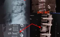 Thay đốt sống nhân tạo cứu một bệnh nhân té cây dừa thoát liệt vĩnh viễn