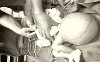 Mắc thoát vị màng não tủy, bé sơ sinh mang khối u khổng lồ ở mông