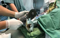 VIDEO: Phẫu thuật thành công cho bệnh nhân dập nát cánh tay do bị cuốn vào máy xay thịt