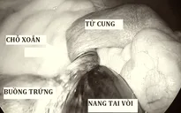 Cẩn trọng với xoắn buồng trứng ở bé gái