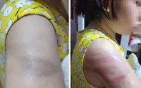 Cô đánh trò bầm tím tay vì viết chậm: Điều không nên xảy ra ở trường học