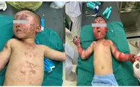 Nghịch lửa trong phòng, hai cháu bé bị mắc kẹt, bỏng nặng