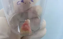 Húp vội bát cháo lòng, người phụ nữ bị xương lợn rơi vào phế quản