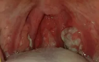 Xuất hiện bệnh nhân bạch hầu tại TP.HCM
