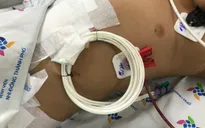Uống nhầm chai nước có axit, bé trai 2 tuổi phải nhập viện
