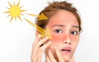 Tạm biệt vết cháy nắng chỉ bằng 3 phương pháp đơn giản