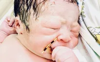 Hy hữu: Mẹ đặt vòng tránh thai, con vẫn nhất định ra đời, mang theo luôn vòng tránh thai "trả" mẹ
