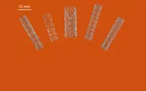 Australia đột phá trong sản xuất stent nhờ công nghệ in 3D