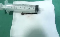 Lấy con vắt dài 8cm sống trong lòng khí quản người đàn ông suốt 2 tuần