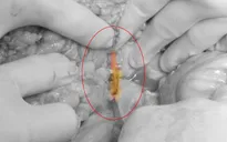 Uống cốc bia có tăm xỉa răng, một người phải nhập viện vì thủng tá tràng