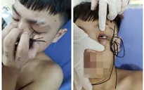 Ngã trong khi đùa nghịch, nam thanh niên bị dây điện móc vào mắt