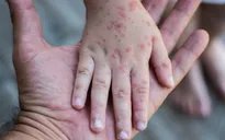 WHO công bố Sri Lanka và Maldives đã thanh toán được bệnh sởi và rubella