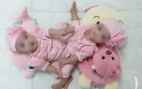 Sẵn sàng phẫu thuật tách cặp song sinh dính nhau cực kỳ hiếm gặp ở Việt Nam