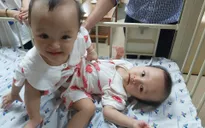 Hành trình chung sống của hai bé gái song sinh dính liền trước ca phẫu thuật tách rời định mệnh