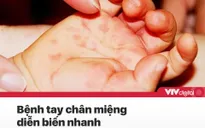 Tin nóng đầu ngày 15/7: Số ca tay chân miệng tăng nhanh, bắt đầu ca mổ tách dính song sinh hiếm gặp