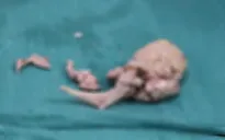 Vào viện cấp cứu vì miếng thịt vịt mắc kẹt ở thực quản