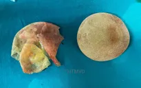 Đau đớn khi đặt túi ngực tại thẩm mỹ tư, người phụ nữ phải phẫu thuật lấy túi ngực vỡ