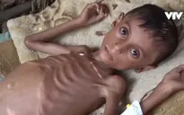 Khoảng 20 triệu người thiếu ăn, Yemen đứng bên bờ vực của nạn đói