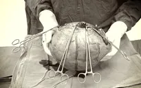 Người phụ nữ mang khối u xơ gần... 10kg trong ổ bụng